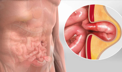hernia symptoms explanation